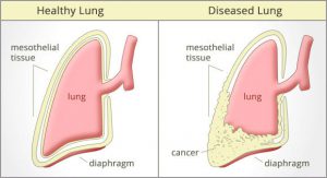 mesothelioma